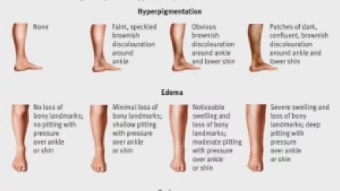 Visuel axe 4 - HERDOO2 score to identify women with unprovoked venous thrombosis