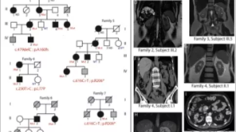 Visuel axe 1 - Pedigrees of the Seven Families with DNAJB11-Associated Disorder