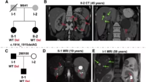 Visuel axe 1 - Characterization of GANAB Mutations in Four ADPKD-Affected Families